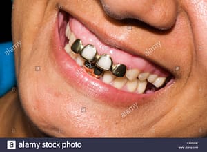 mouth-of-native-with-gold-teeth-and-dental-work-central-america-BAWX4K